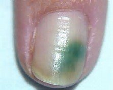 Effective Ways to Handle a Greenie Nail Infection